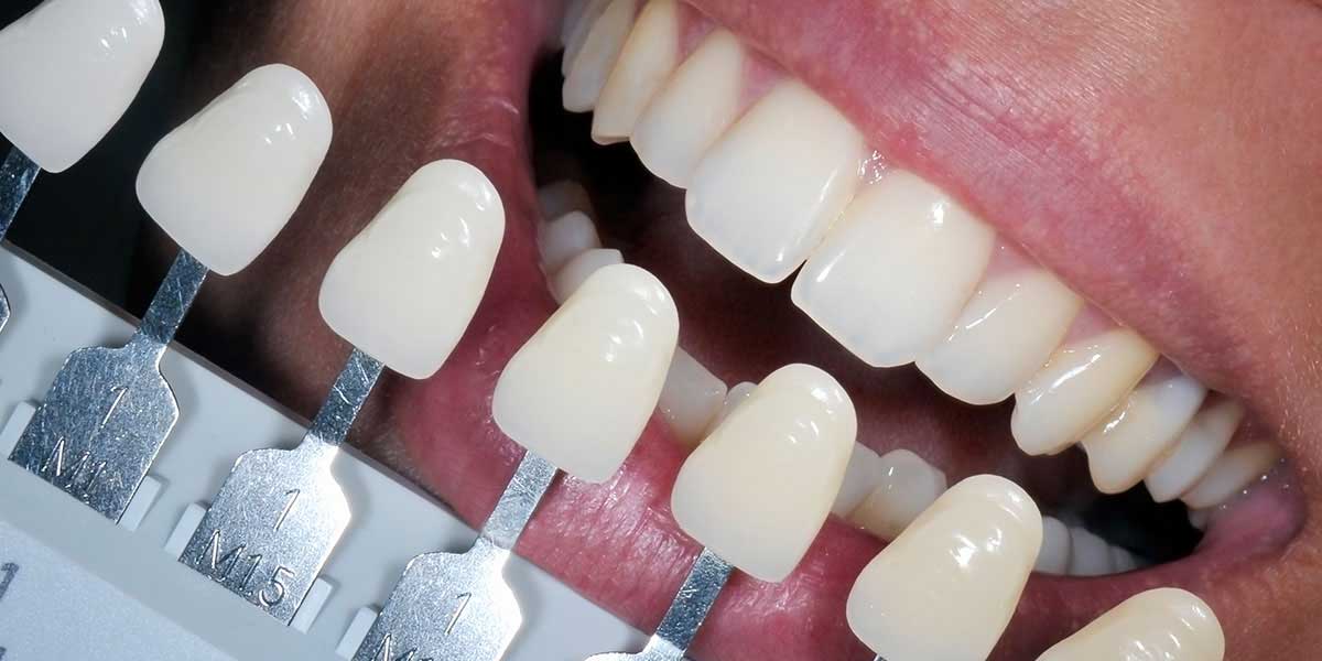 Tooth Filling, Veneers, or Dental Bonding?